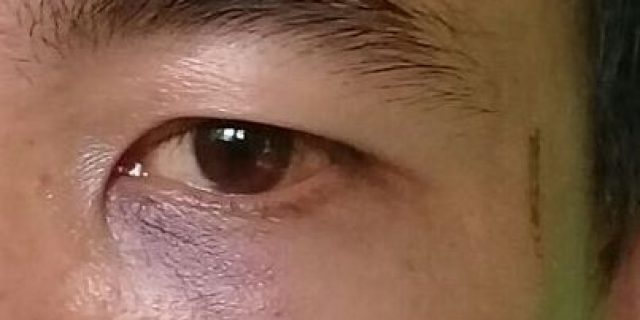 Tampak bekas luka lebam dan lecet diwajah korban.